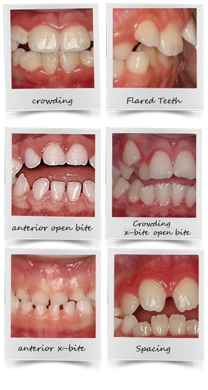 Narrow Palate
Mouth Breathing
Tongue Thrusting
Crooked Bite
Crowding
Dental Cavities
Grinding