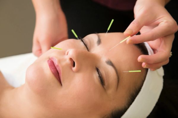 Woman receiving facial acupuncture treatment with needles on her face.