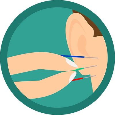 Puntos de acupuntura utlizados en el tinnitus