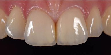 Οι ολοκεραμικές στεφάνες μιμούνται τα φυσικά δόντια και το αισθητικό και λειτουργικό αποτέλεσμα είνα