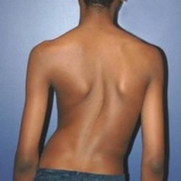 chiropractor Allentown PA, scoliosis, misalignment, back pain, neck pain, poor posture