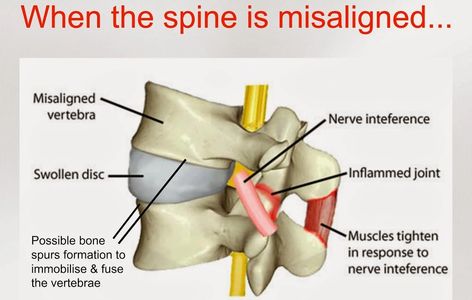 chiropractor Allentown, pinched nerve, spine misalignment, pain, subluxation, what is chiropractic