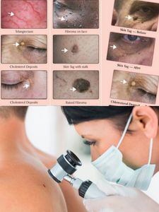 Skin tags removal
Cherry angiomas removal
Sebaceous hyperplasias removal
Milia removal