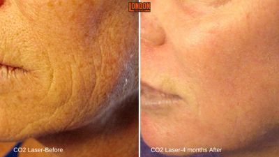 laser, age spots, wrinkles, lines, pigment, resurfacing, chemical peel, facial laser, anti-aging