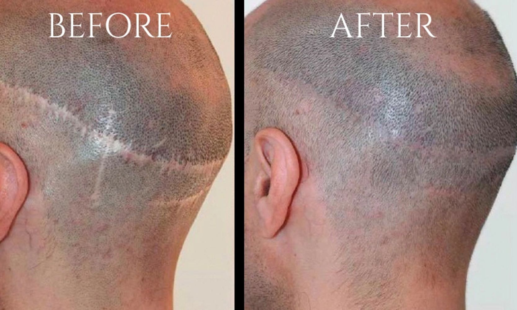 Scar Camouflage and Scalp Micro Pigmentation