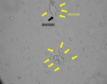 腫瘤免疫細胞治療