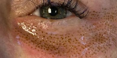 fibroblasting fibroblast skin tightening plasma tightening