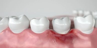 Series of teeth with an affected gum called Gingivitis.