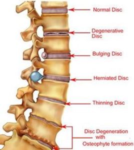 illustration of disc problems