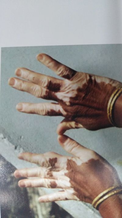 Vitiligo on hands of a Indian woman.