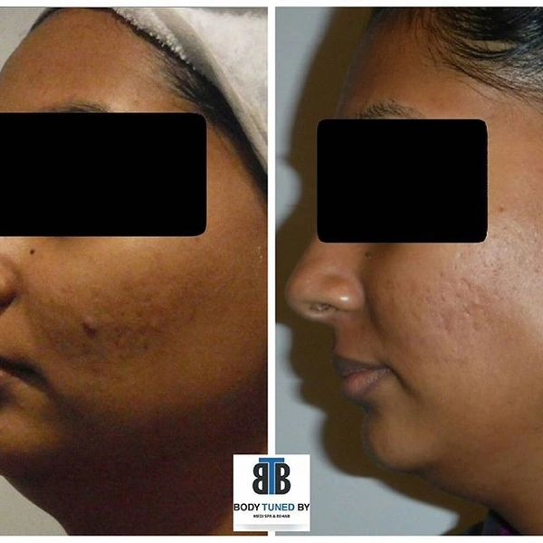 #acne #acnereduction #carbonfacial #acanscarring #evenskin #darkskintreatment #laserclinic #facial