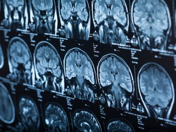 Din Neurology treats Seizures and Epilepsy