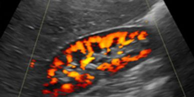 Kidney Ultrasound with Doppler