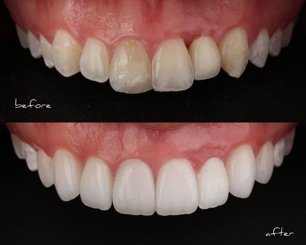 veneers in Arlington, TX