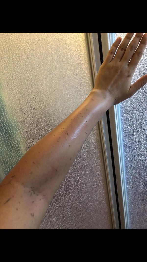 visible dead skin being peeled off from using the bondi myst body mitt. Natural glow seen afterwards