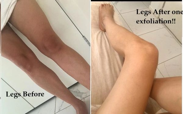 before & after of skin pigmentation of using the body mitt. Exfoliation helps even out the skin tone