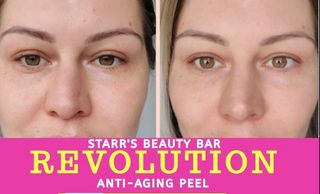 pq age chemical peel
