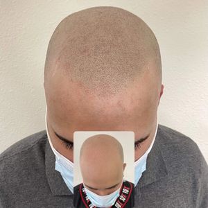 Scalp Micro pigmentation is an amazing technique creating the illusion of a tightly buzzed hair cut.