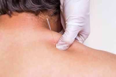 Thin needles inserted into the skin at specific points to various depths.