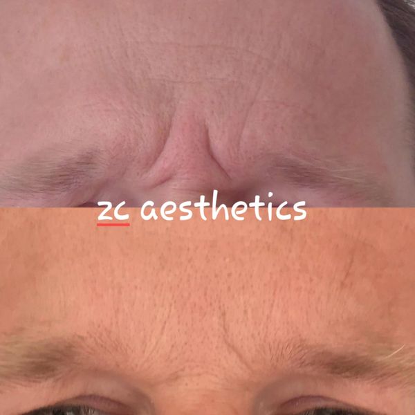 botox, antiwrinkle, jaw, sweating, necklift, frowns, crows feet