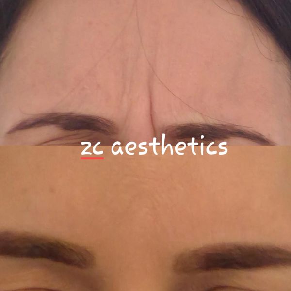 botox, antiwrinkle, frown lines