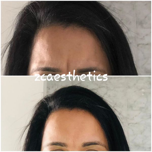 Botox, Antiwrinkle injections, smooth lines, sweating, neck lift, jaw