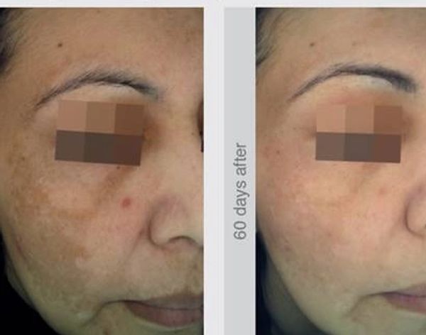 pigmentation
