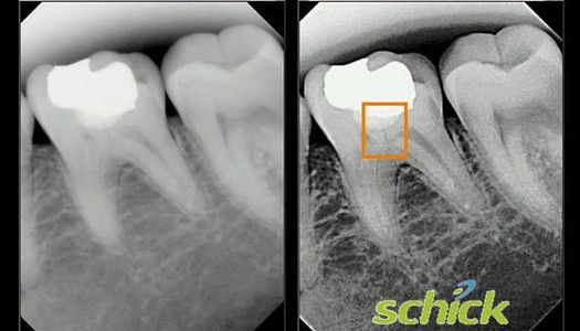 Typical x-ray image vs. our high def x-ray!