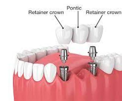 Implant supported dental bridge.