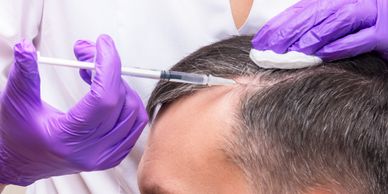 Pour traiter les débuts de calvitie et prévenir la chute du cheveu, le PRP Cheveux utilise les facte