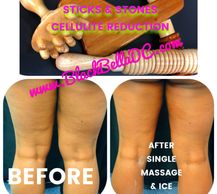 Restore collagen & reduce dimpling. We'll recommend a treatment plan for Stage 1, 2 or 3 Cellulite.
