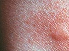 Hives, or urticaria, are itchy welts on the skin that appear suddenly and may vary in size and shape