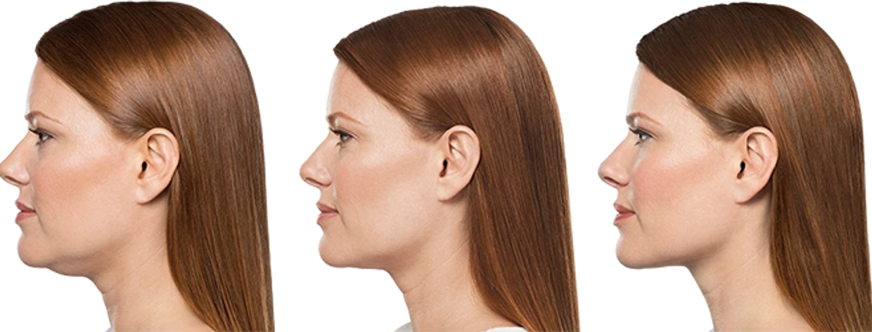 three females showing a double chin getting smaller in each picture