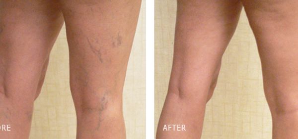 two sets of legs showing the back of the legs with veins showing, less in the second picture