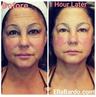 Jade Facial Systems, NonInvasive Face Sculpting, Non-Surgical Face Lift, Skin Tightening, Rejuvenate