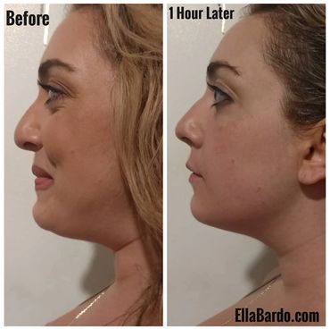 Jade Facial Systems, NonInvasive Face Sculpting, Non-Surgical Face Lift, Skin Tightening, Rejuvenate