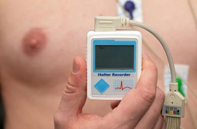 24 hr Holter monitoring for bradycardia tachycardia conduction blocks with syncope and palpitations