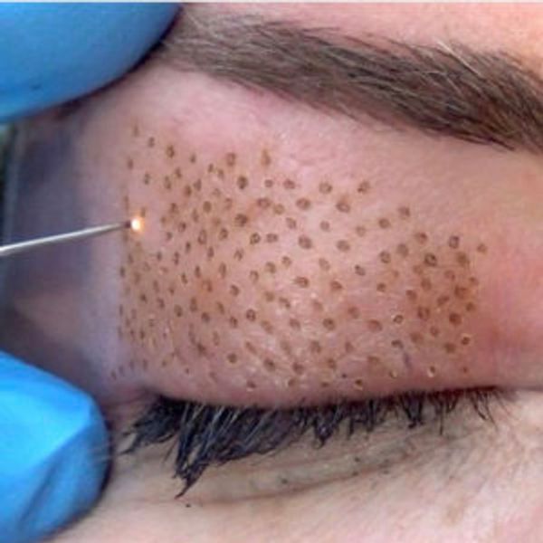 It delivers tiny arcs of plasma created by an electrical discharge via a “plasma pen” to the skin.