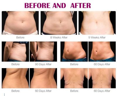 Fat freezing is recommended for localized stubborn areas.