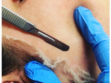 dermaplaning facial
