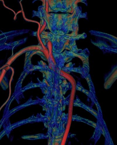 Cone beam computed tomography (CBCT) is a medical imaging technique similar to computed tomography.