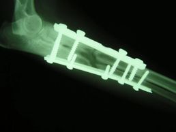 Bone plating and bone graft visible on radiographs of a dog with a severe fracture of the radius and ulna.