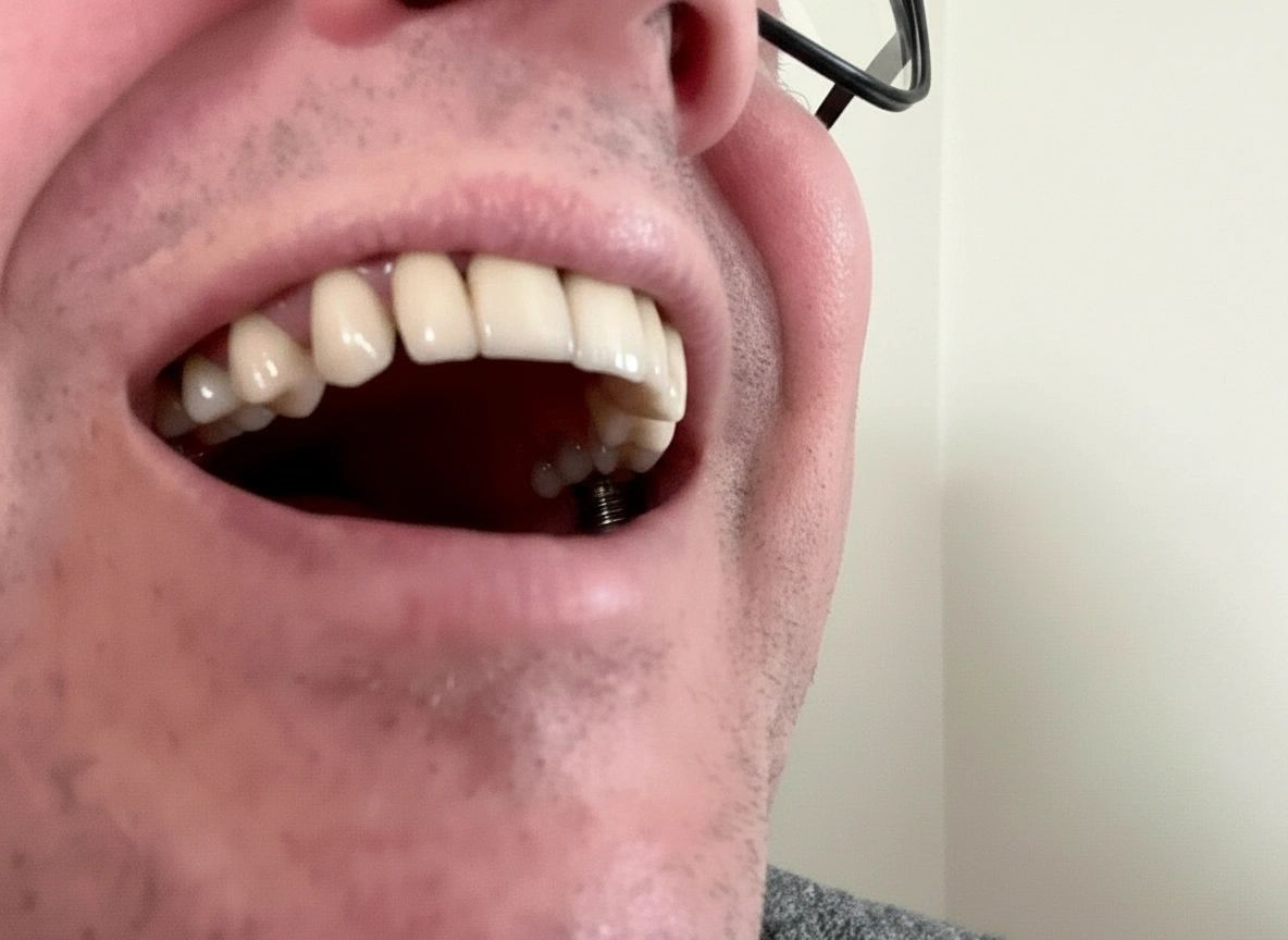 Dental Implants — after treatment at Best Dental Care Tyler