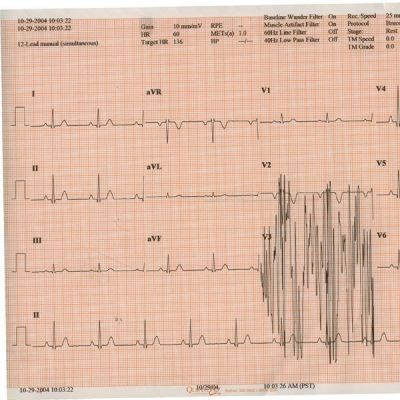 ECG/EKG Recording Paper Thermal Paper 8-1/2 Inch X 183 Foot Z-Fold Red Grid , 20 Pads/Case , Cardinal 9019