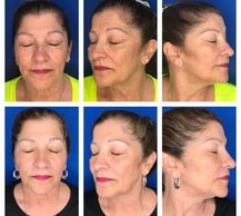 Tribella:
IPL
Skin Tightening
Viva Frac Radio Frequency