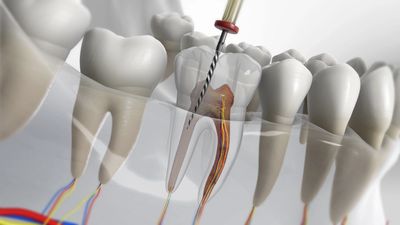 Root Canals