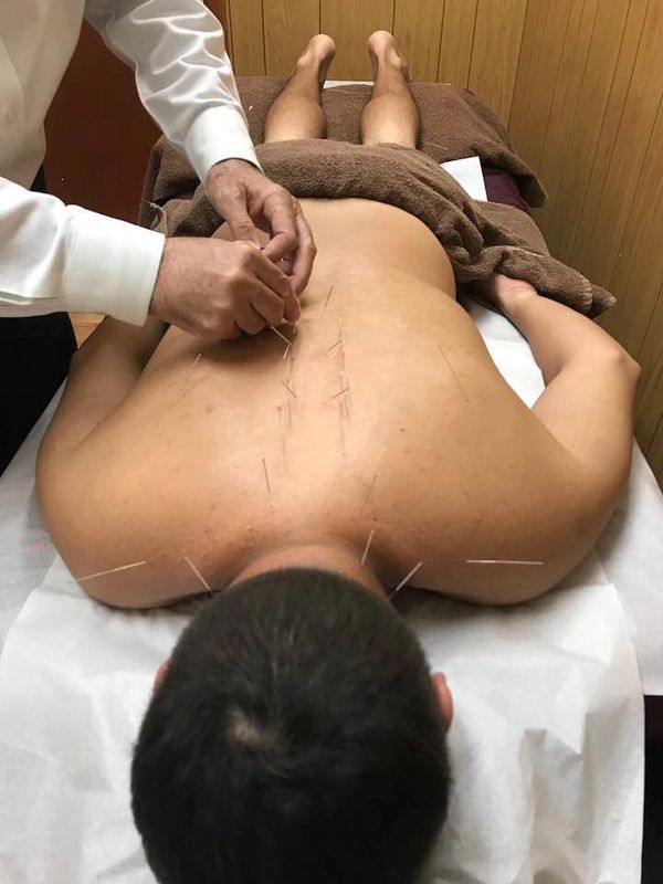 Foto del tratamiento de Acupuntura para el dolor de espalda