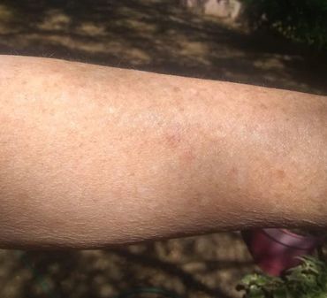 Skin cancer is gone after about 5 weeks of using Rose Frequency Creme