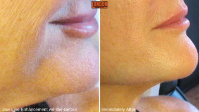 jawline filler, jowls, lips, chin augmentation, 