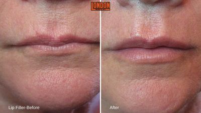 lip enhancement,filler,juvederm,restylane,lip fullness, 